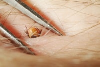Paralysis Tick Removal