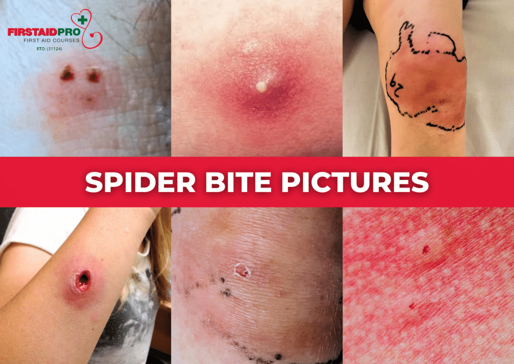 Australian spider Bite pictures