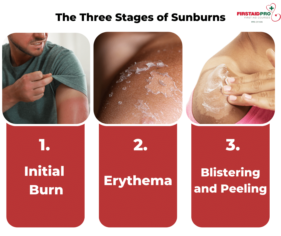 The Three Stages of Sunburns