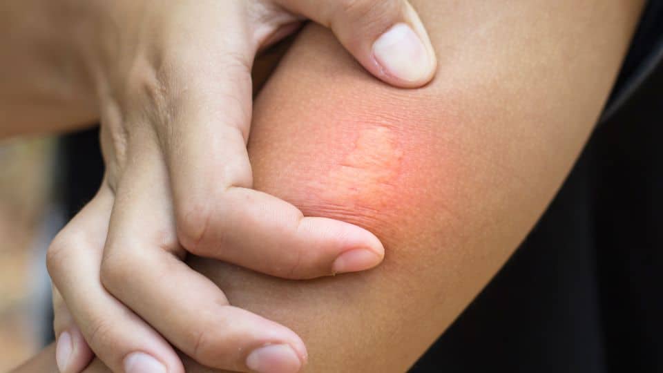 Allergic reaction caused by sting