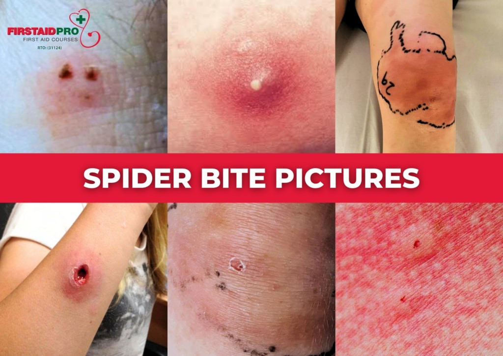 Common Spider bite picture