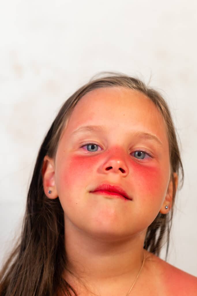 first degree burns - sunburn