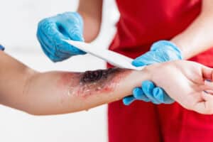 First Aid Training for severe burns Workplace First Aid for Burns