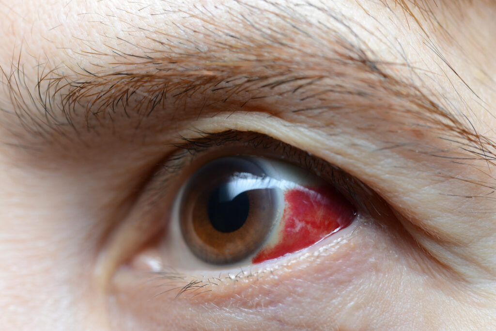 types of eye injuries