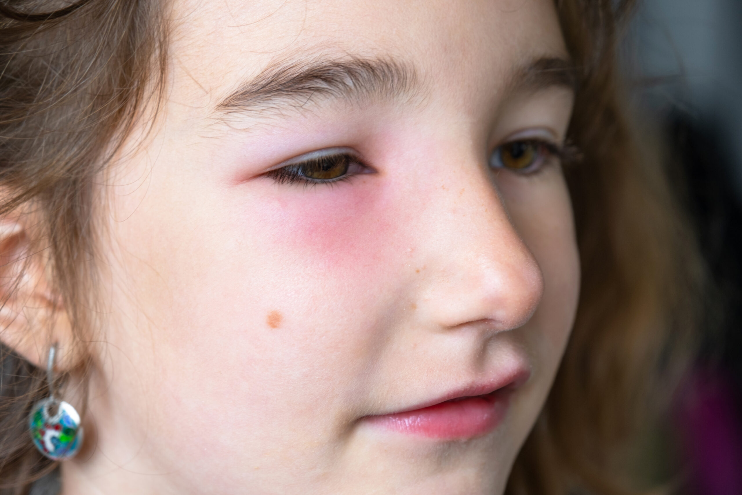 kids' eye injury