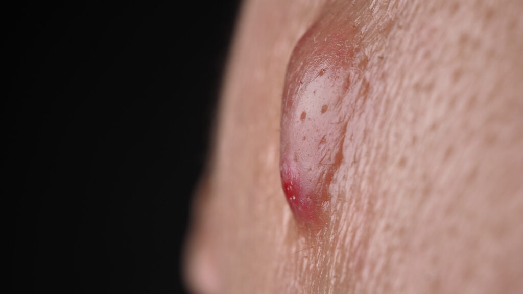 spider bite appearance on skin