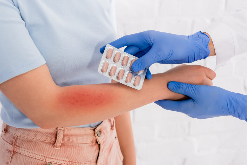 Cropped view of doctor in latex gloves holding pills near woman with allergy redness on arm