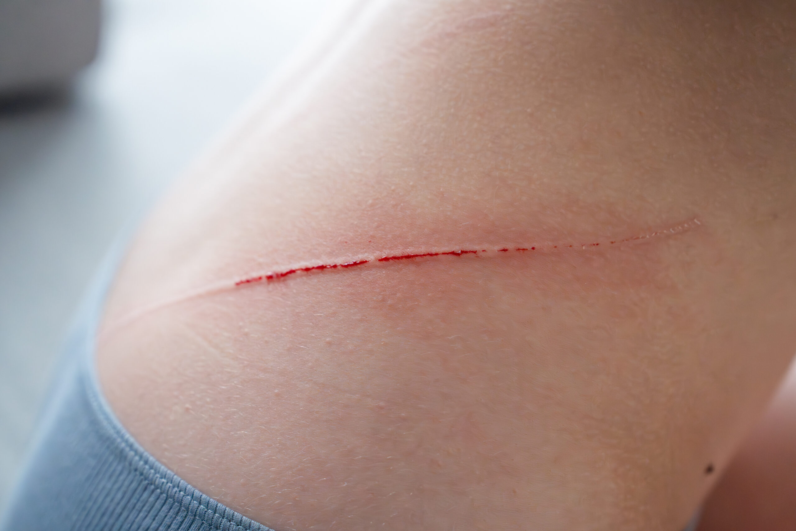 prevent wound infection