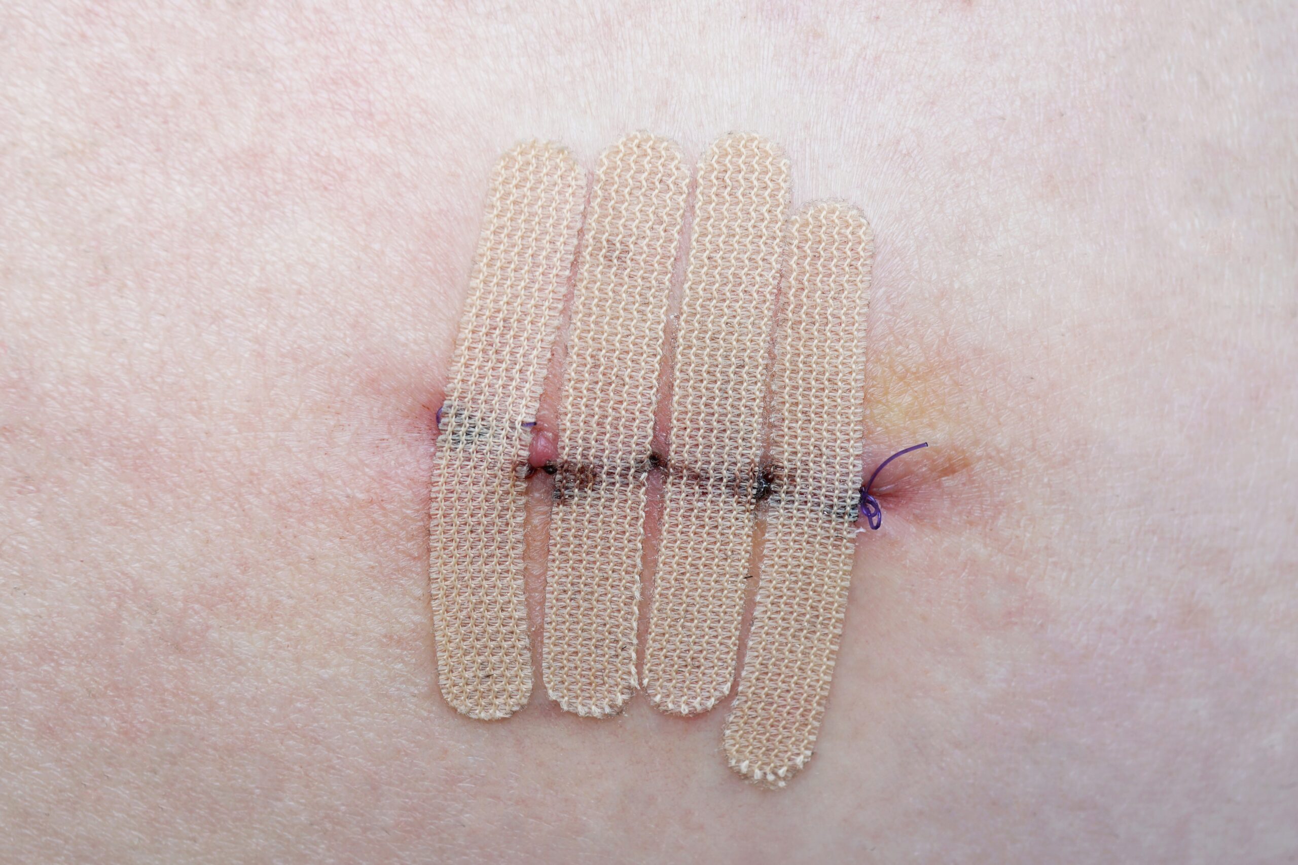 skin with suture and wound closure strips or surgical tape