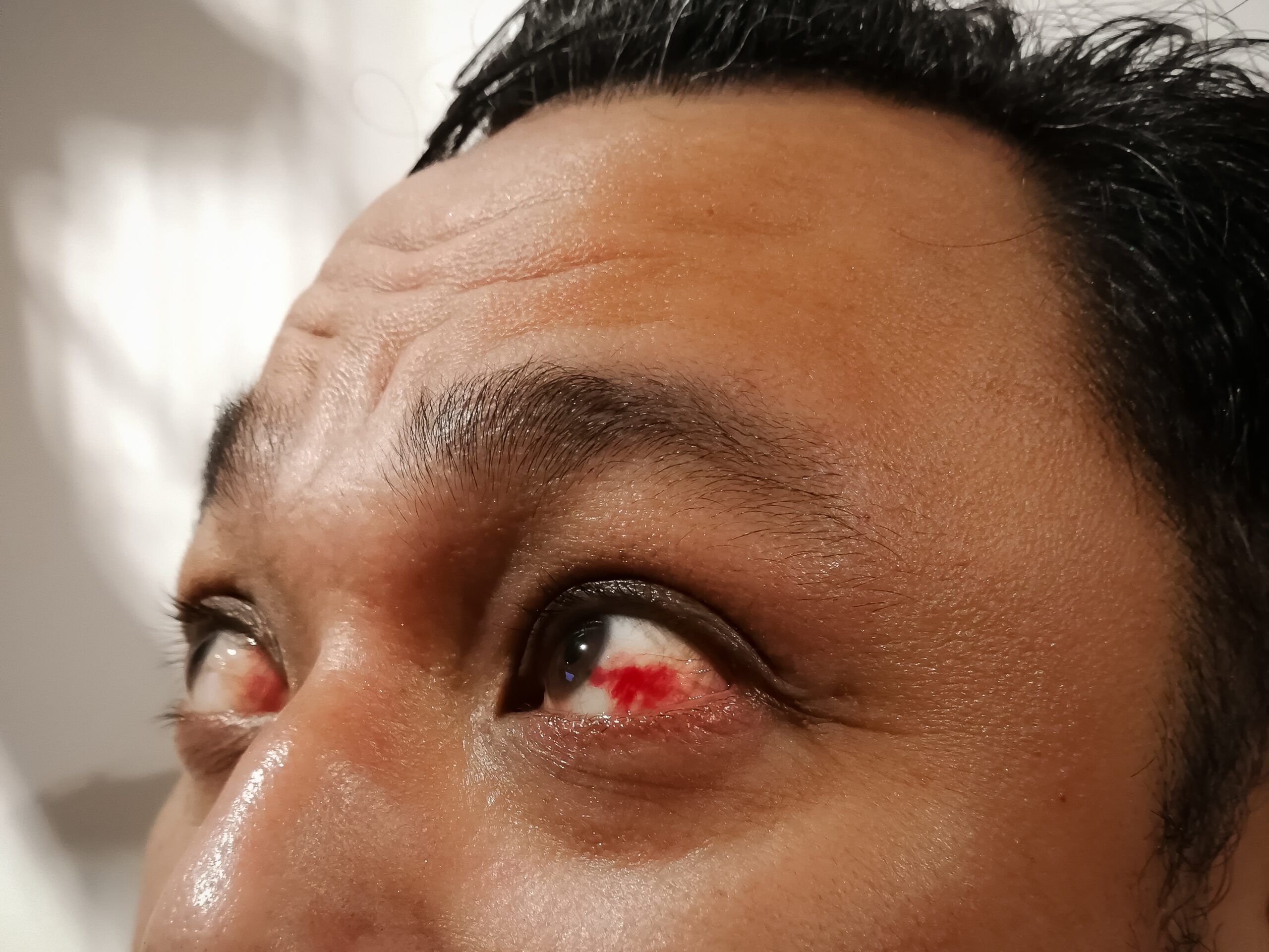 Bloodshot eye. Asian man with burst blood vessel in eye. Very re
