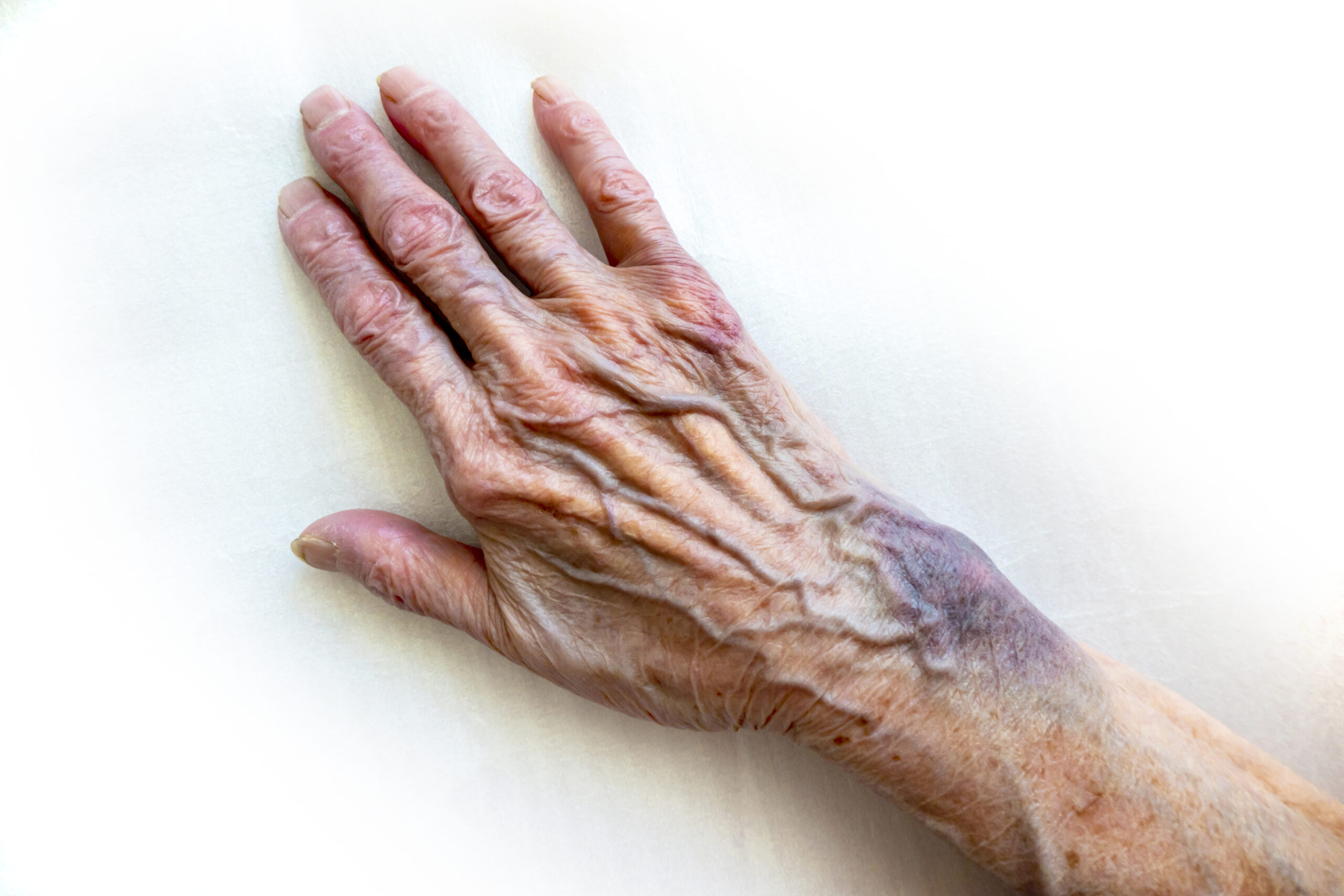 hot water burns on elderly hand