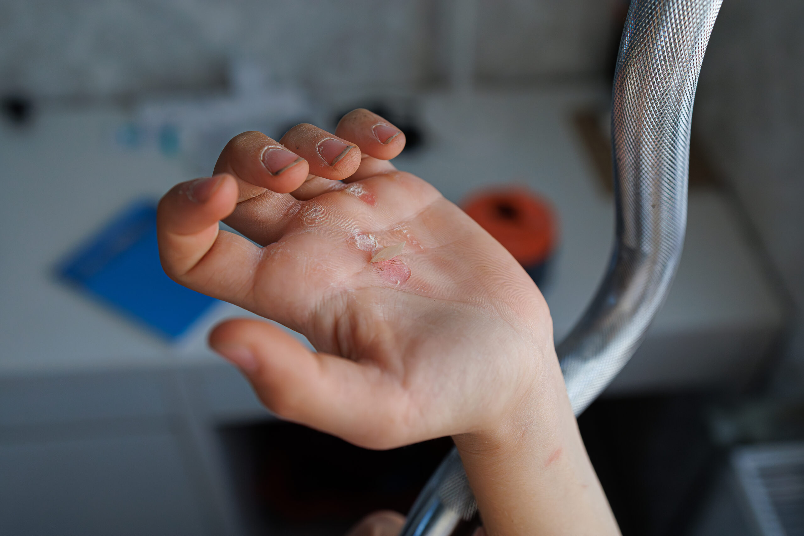 A lacerated callus on the palm of my hand