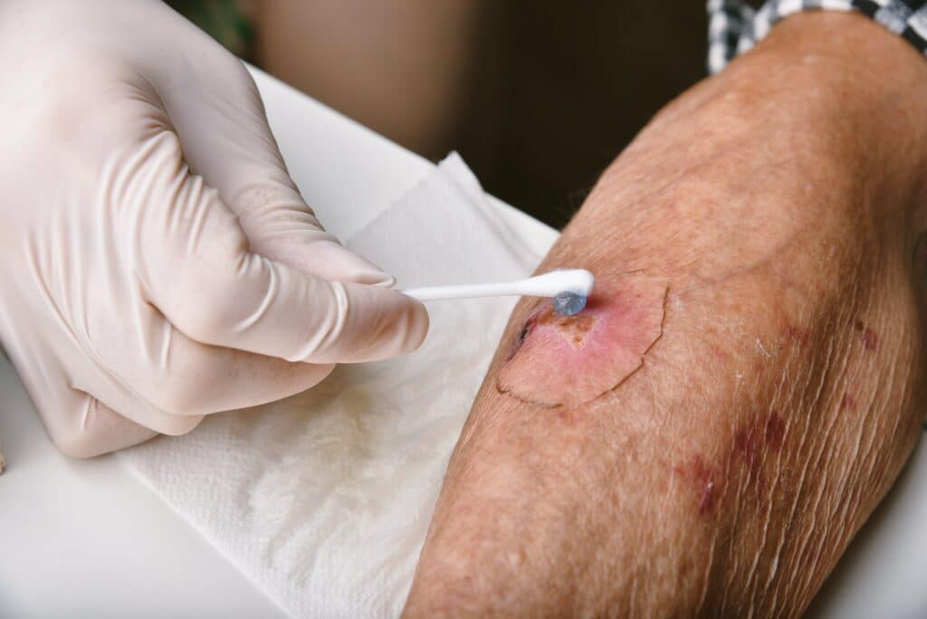 Wound dressing, Doctor applying medicine to infected wound in chronic diabetes senior patient, Accidental wound care treatment in elderly old man.