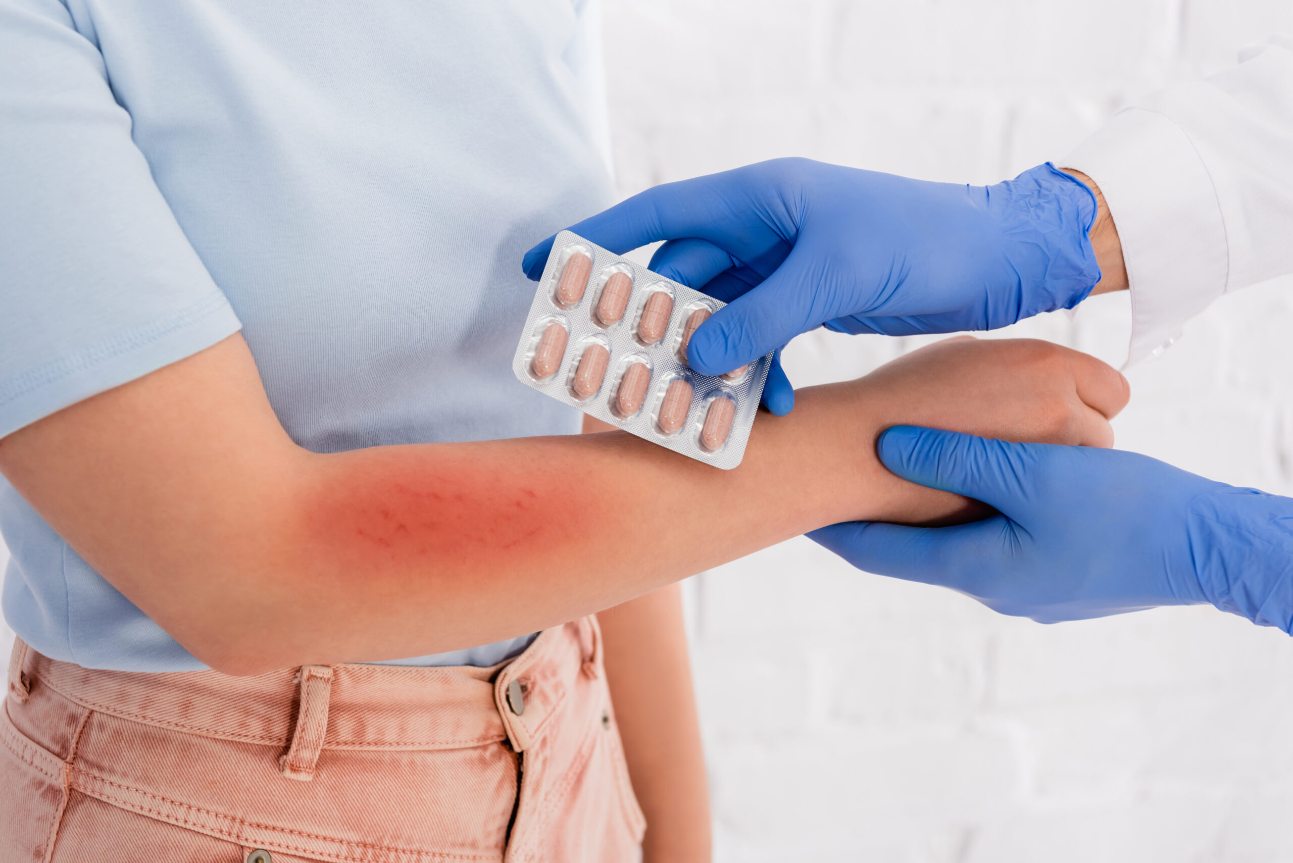Cropped view of doctor in latex gloves holding pills near woman with allergy redness on arm
