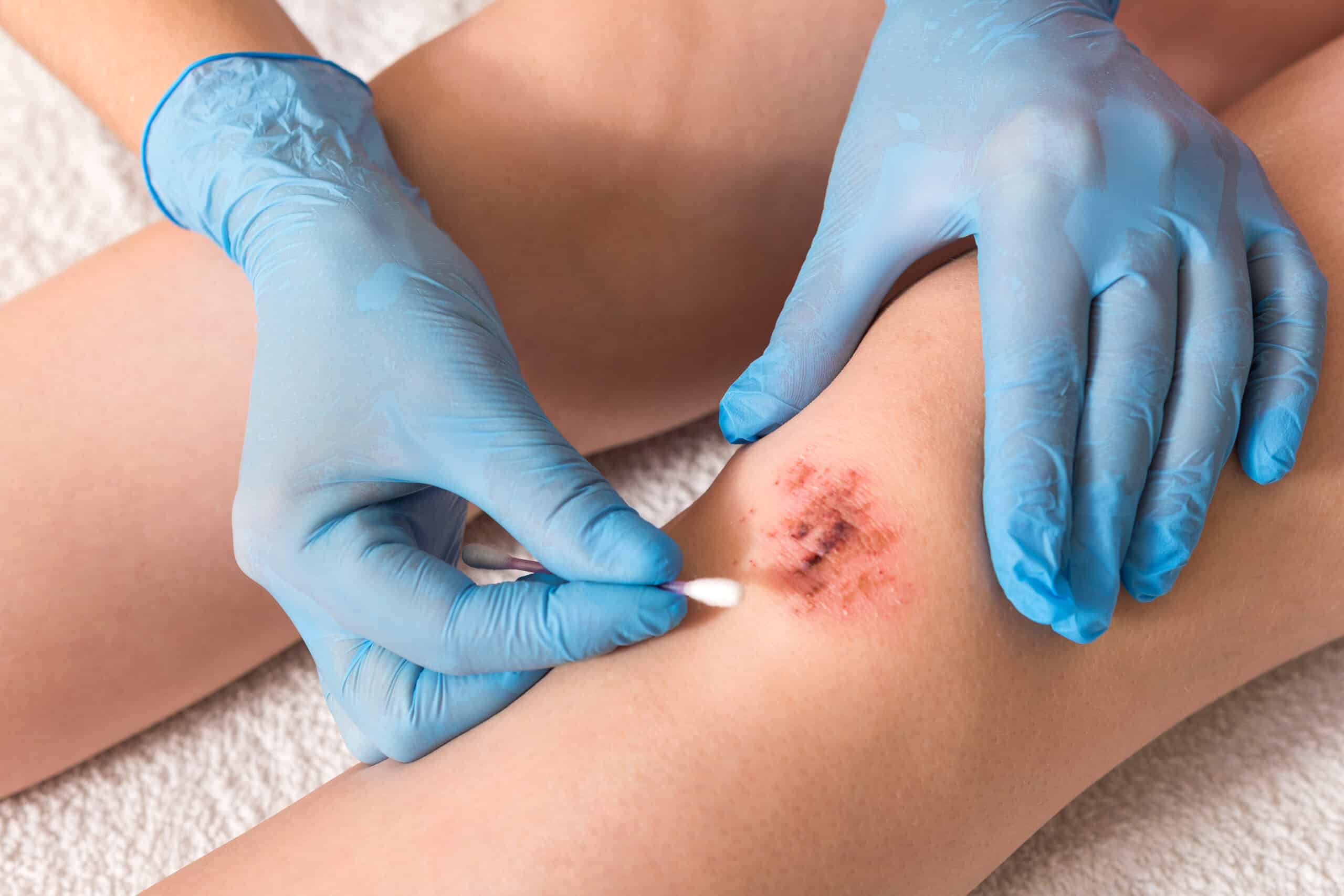 Injured leg wound knee with blood and doctor's hands in blue medical gloves treats a patient, treats a wound