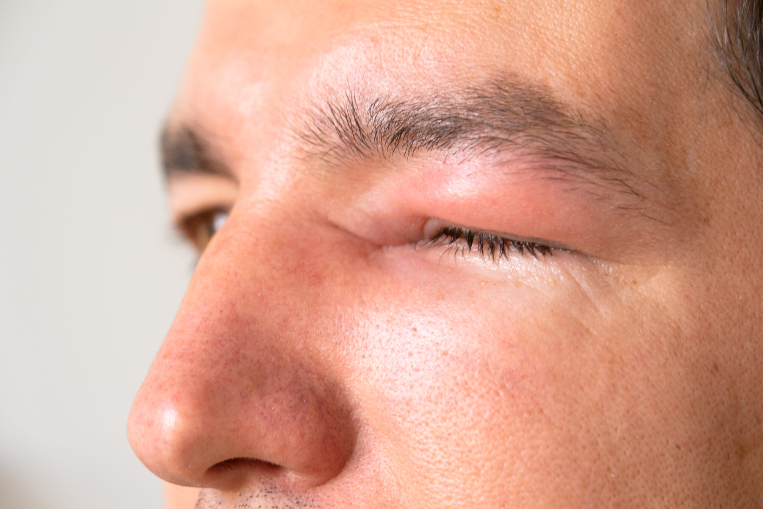 A red swollen eyelid on a man's face in close-up is an allergy to an insect bite. Allergic reaction to blood-sucking insects