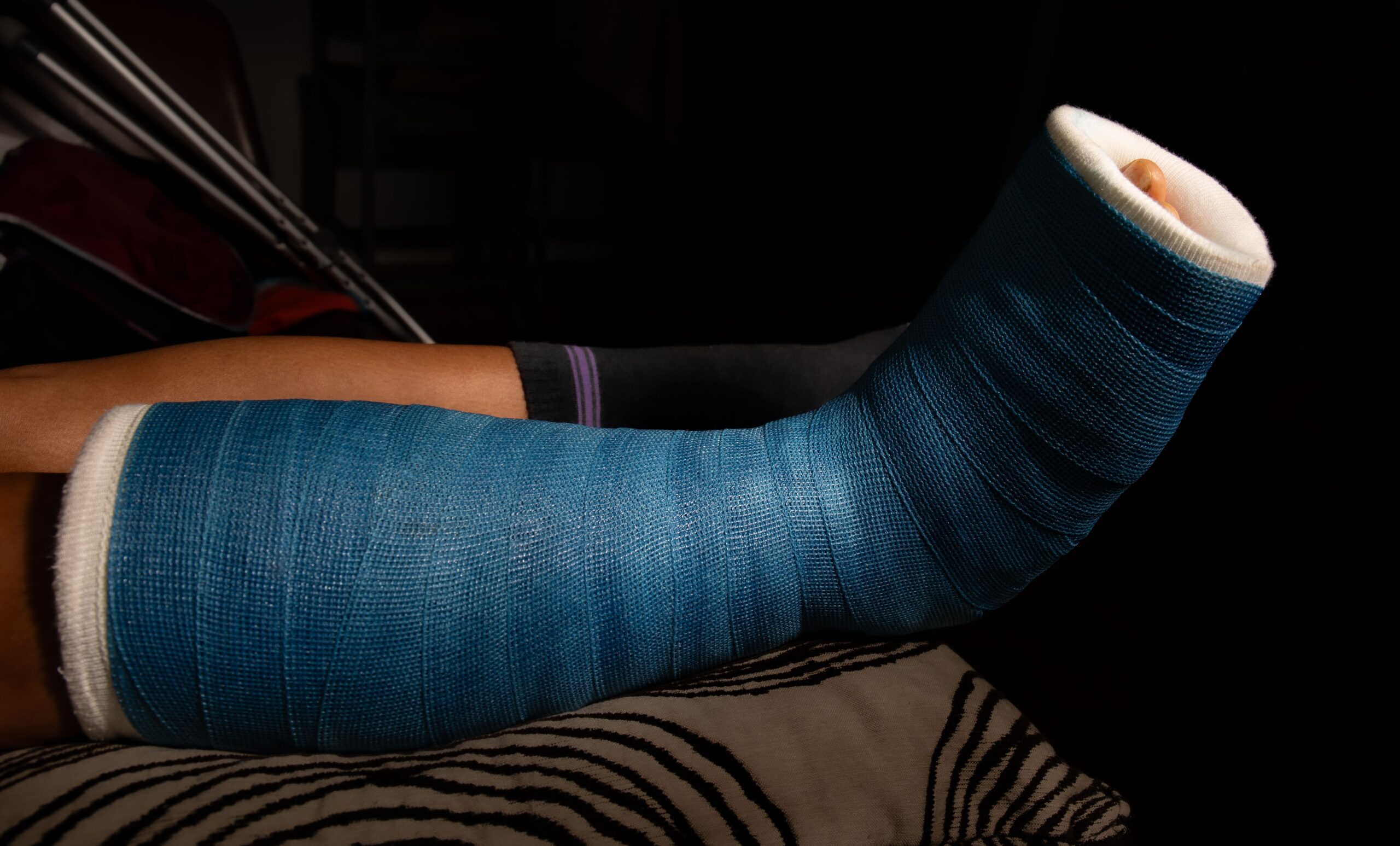 A closeup of a person's leg in a cast due to a fracture.