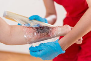 Home Remedies for Minor Burns