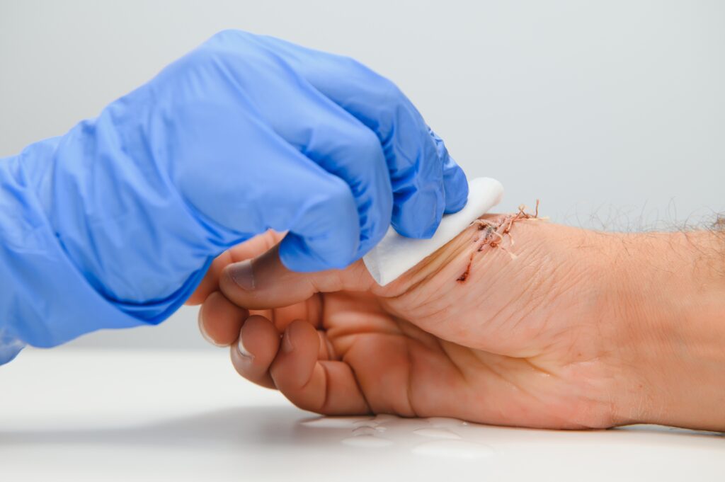 Suture wound on hand,Pain of accident concept
