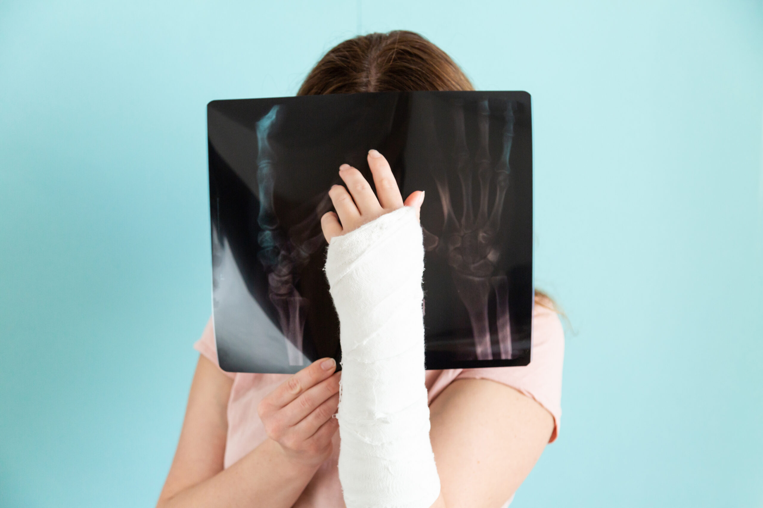 A woman in despair holds an x-ray. Broken arm, collapse of plans, depression, pain, shock. Broken arm in a plaster cast, gypsum bandage.