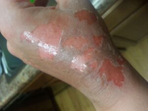 Treating Second-Degree Burns: A Step-by-Step Guide