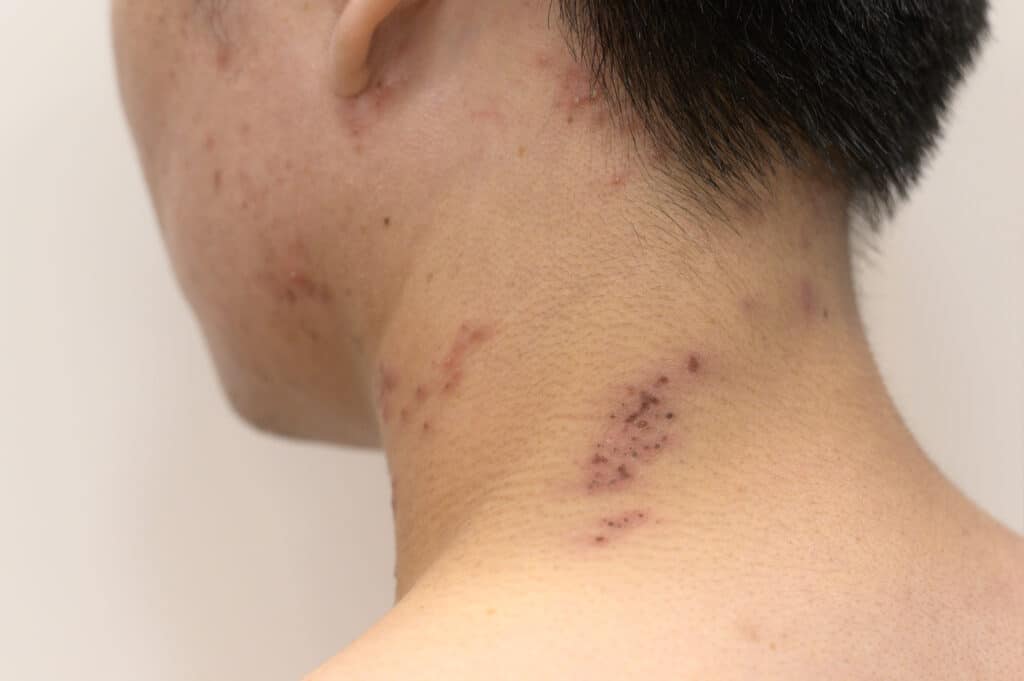 Man with shingles rash on his neck.