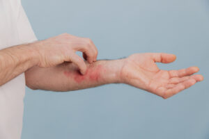 insect bites and stings