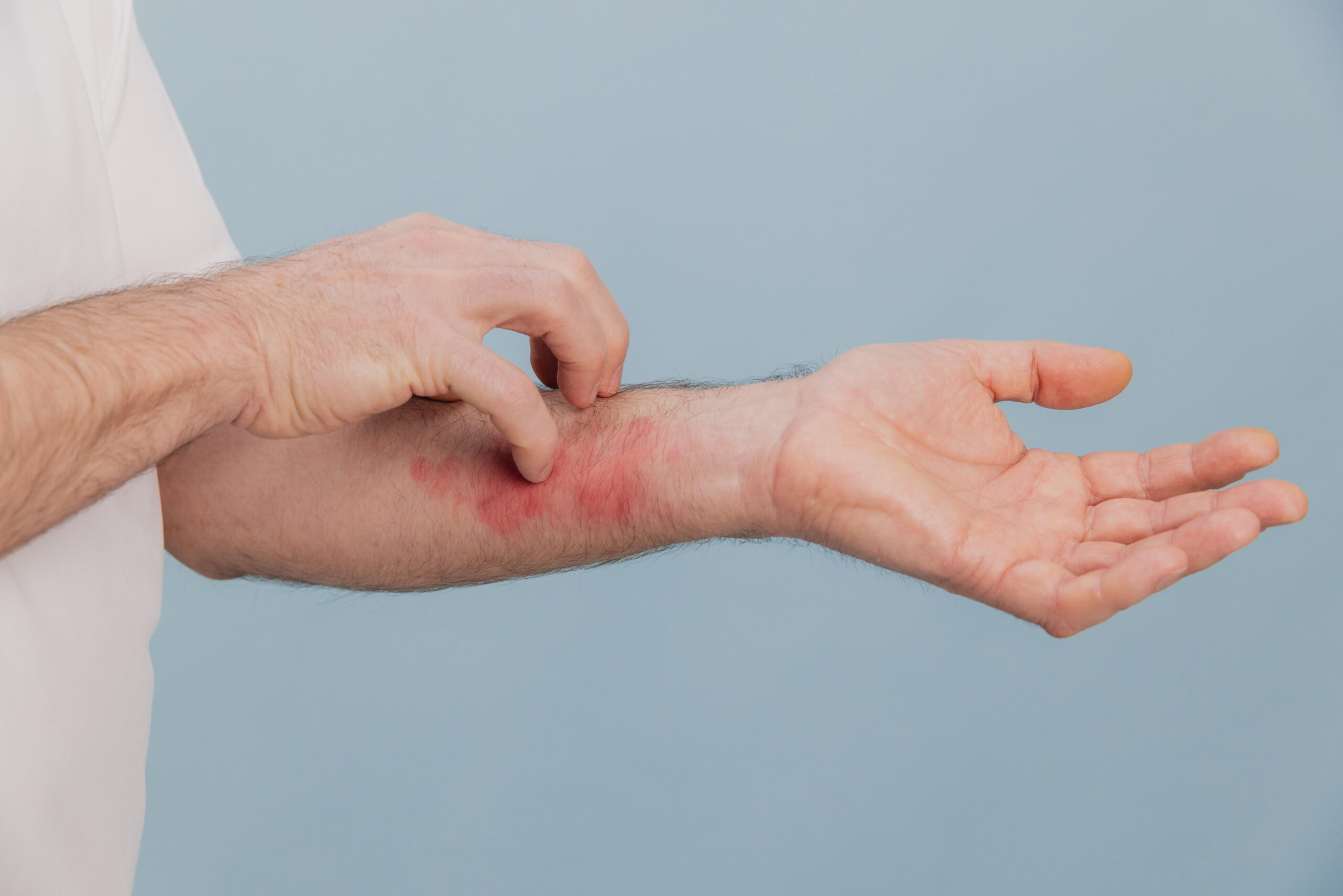 insect bites and stings