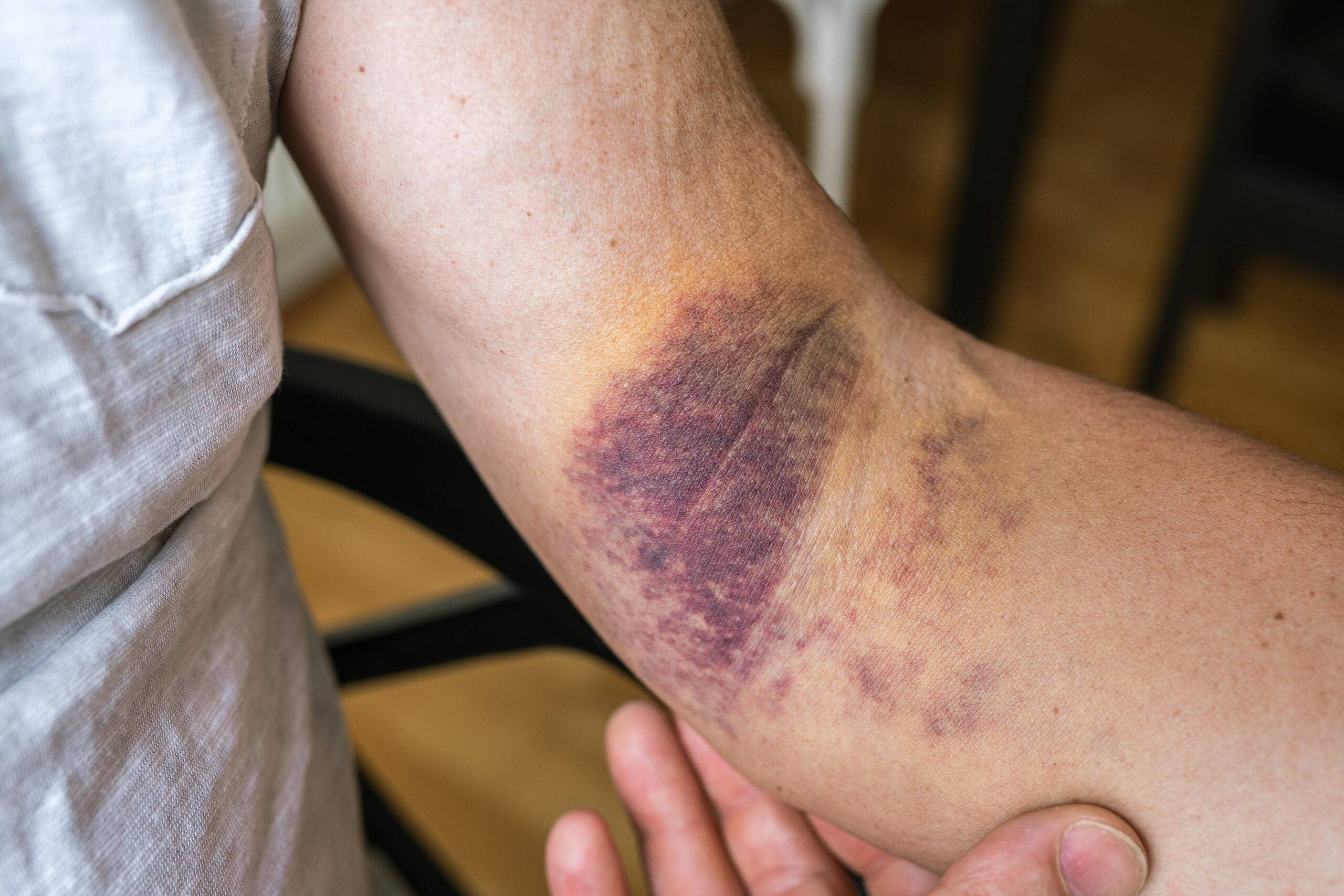 Intense bruising from dislocated elbow joint, ligament damage on man, muscle, ligament sprain in sports, inflammation, injury. Bruise, bruise, veins, blood vessels, close-up on injured arm muscular