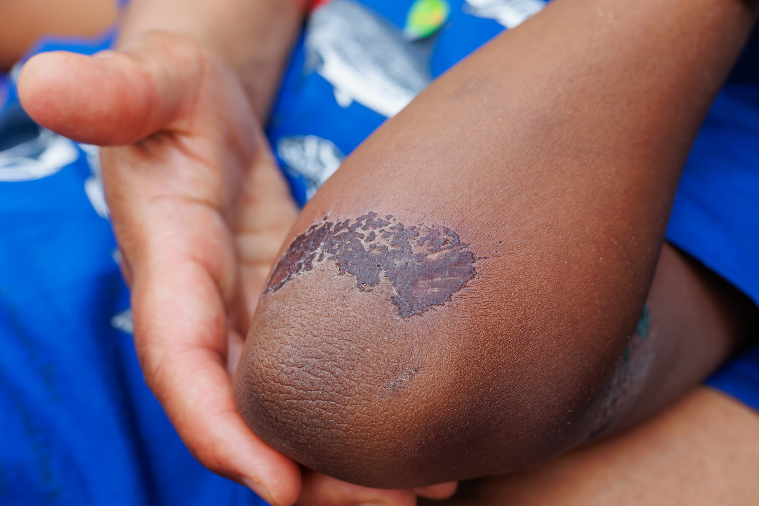 Large, healing scab on the arm of a young boy of african ehtnicity