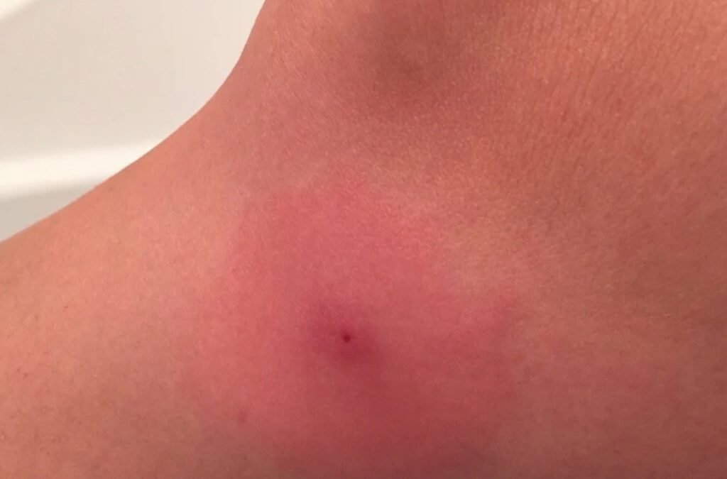 redback spider bite
