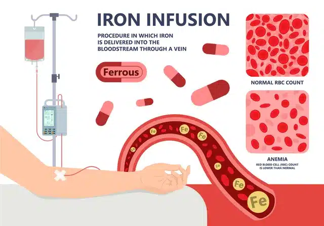 iron infusion