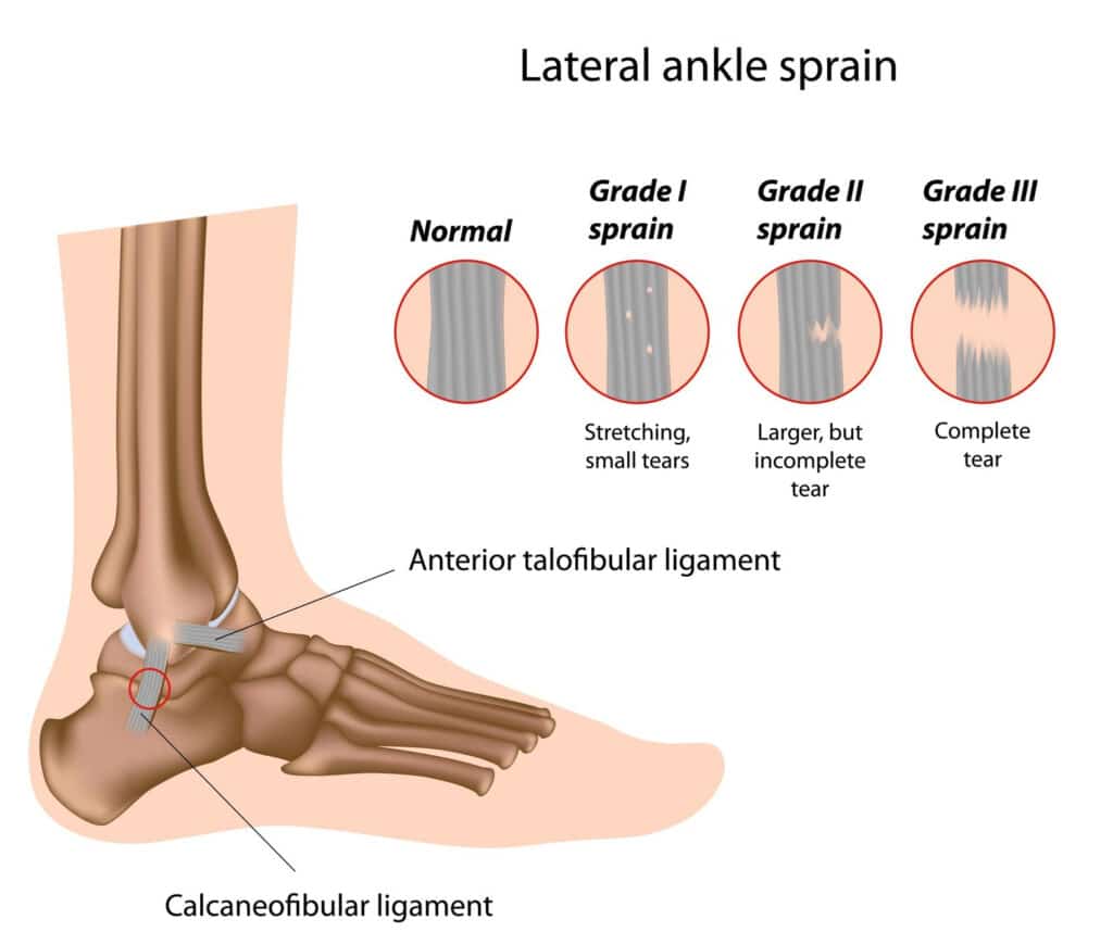 sprain - grades of ankle ligament sprain