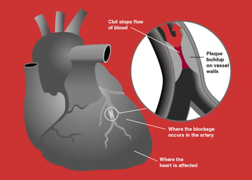 heart attack diagram
