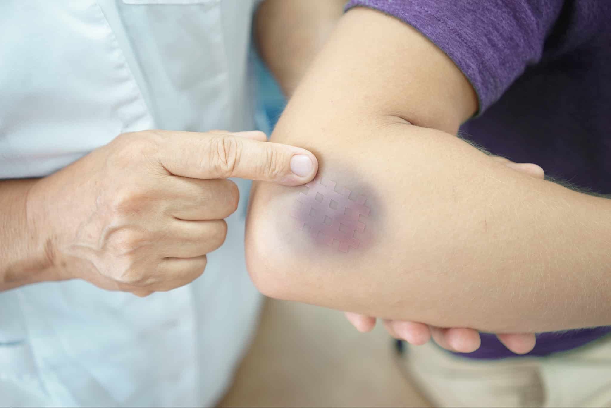 treat a contusion wound